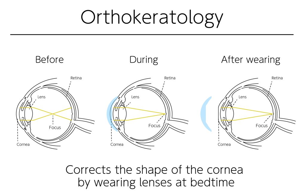 Orthokeratology