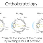 Orthokeratology